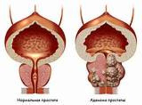 Удаление аденомы простаты на гольмиевом лазере